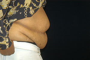 Abdominoplasty3